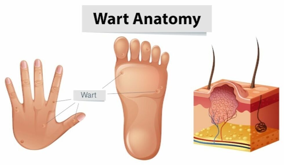 Successful removal of warts along with the root using Removio