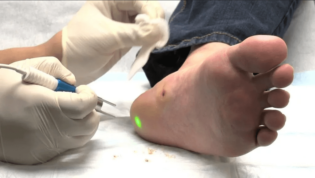 Treatment of the plantar wart