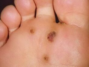 How to get rid of a planar wart