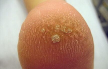 How to know a Pierce wart