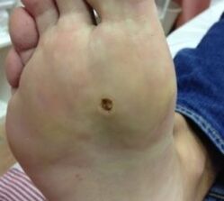 Ways to remove the wart on the sole of the legs