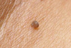 Clinical picture of papilloma