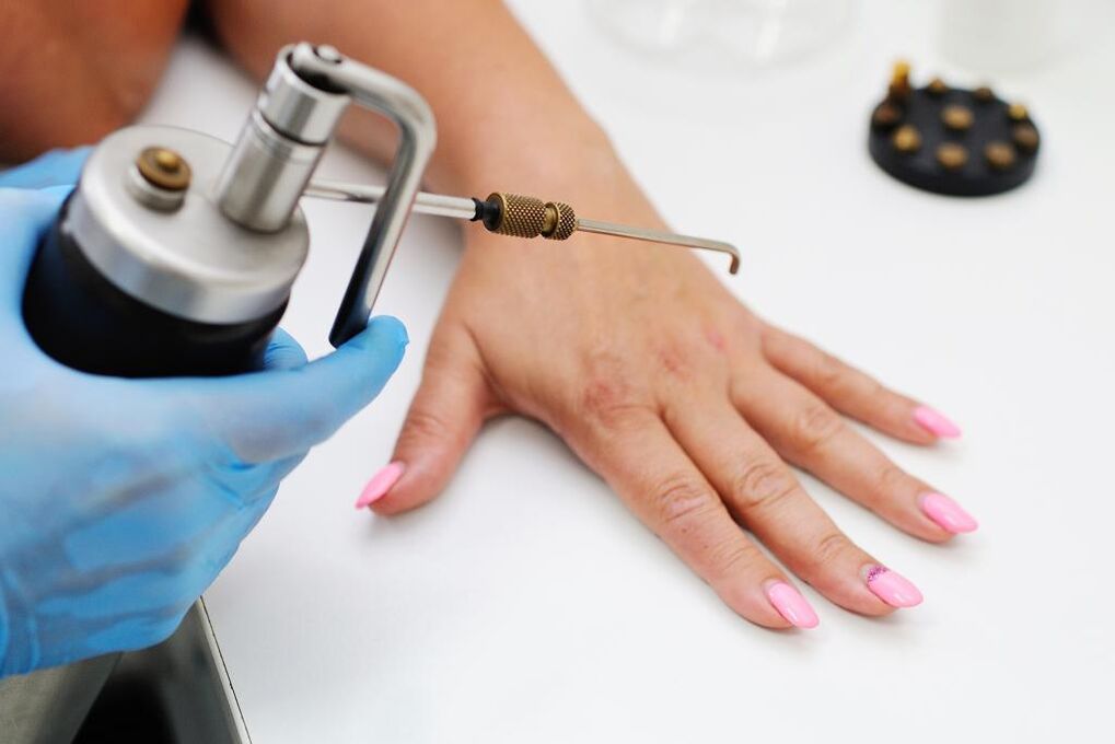Papillle removal with liquid nitrogen