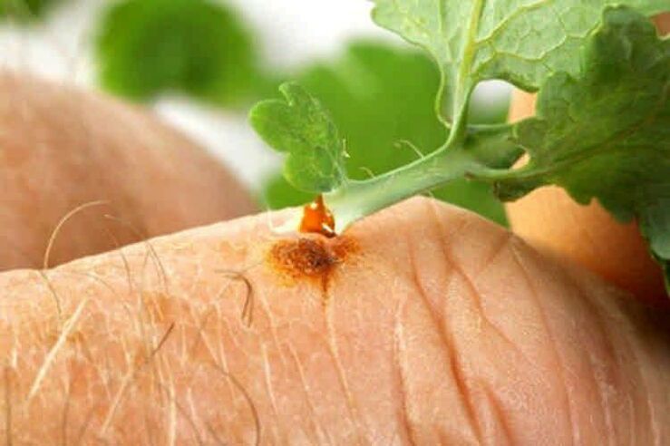 How to remove papillomas with popular remedies