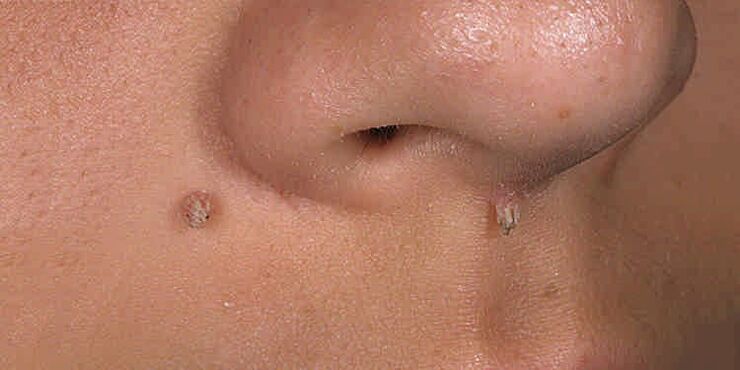 Reasons for appearing papillomas