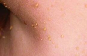 Reasons for appearing papillomas in the body