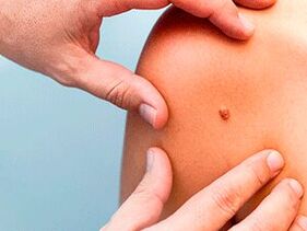Reasons for appearing papillomas in the body