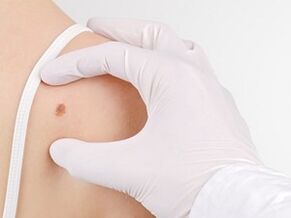 What is the risk of having papillomas in the body