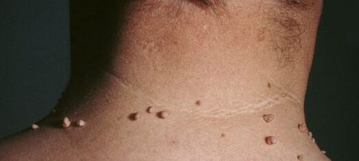 How to get rid of papillomas