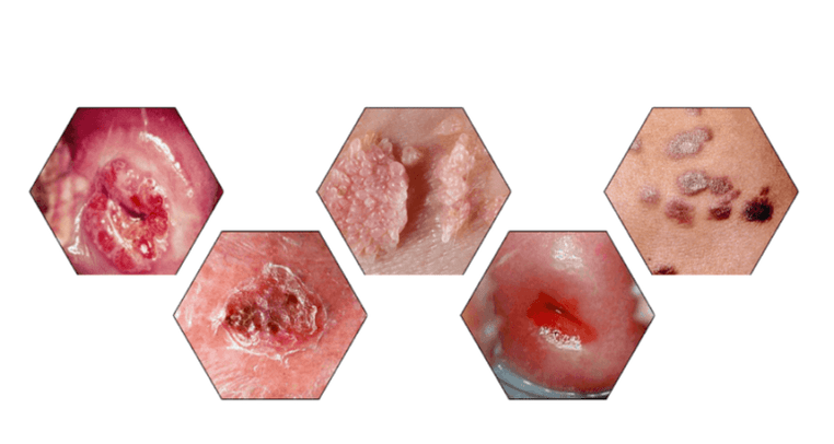 Why are papillomas dangerous