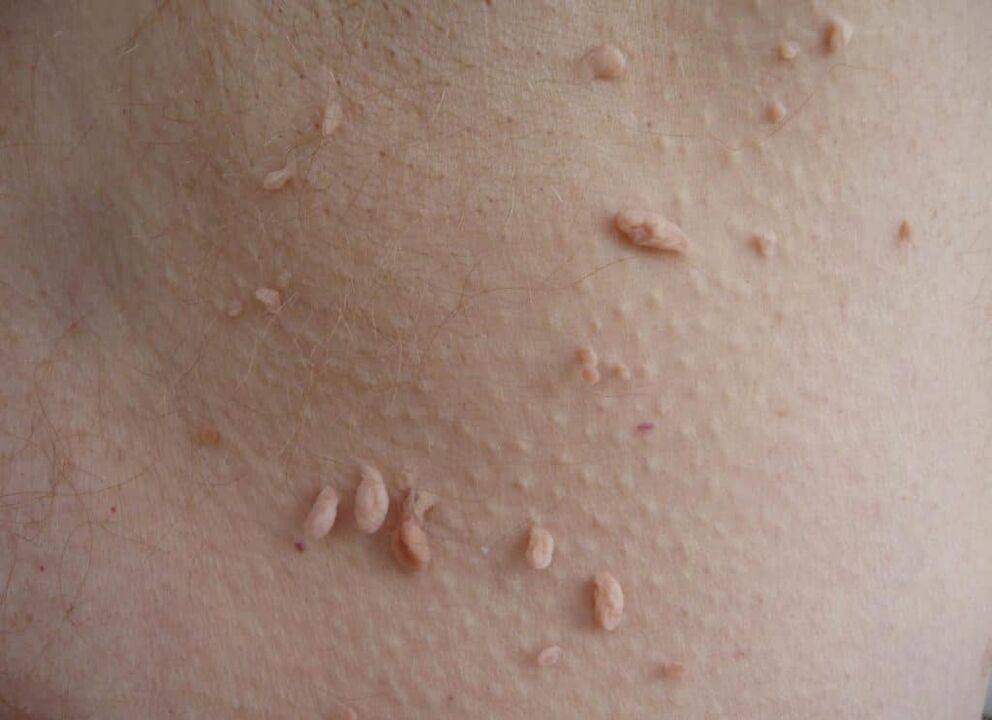 the reasons for the appearance of warts on the human body