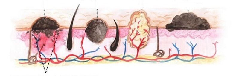 Types of papillomas in the human body