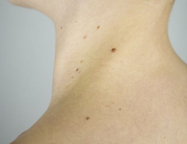 Papilloma on the neck of a girl