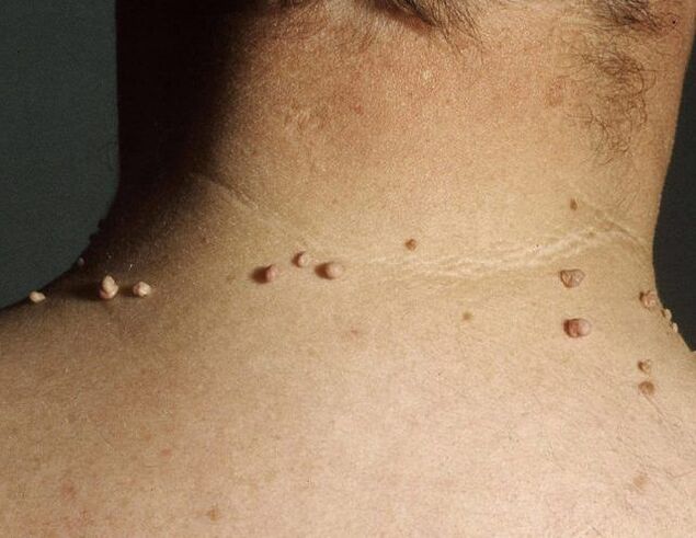 Papilloma on the neck of a man