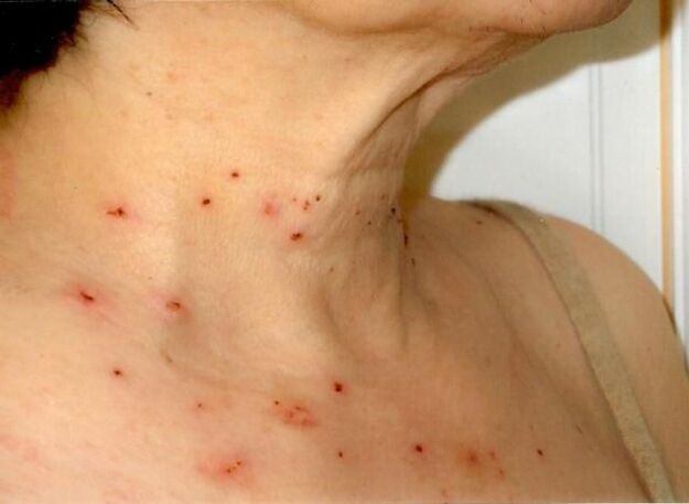 Results of treatment of papillomas in the neck