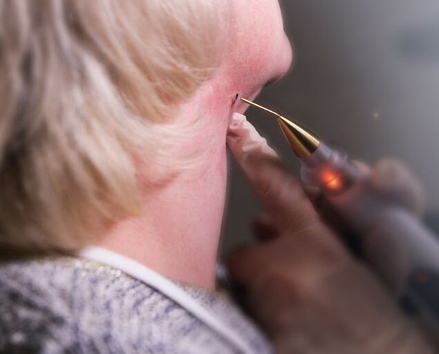 The process of removing a papilloma on a woman's neck