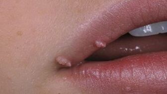Papilloma on lips