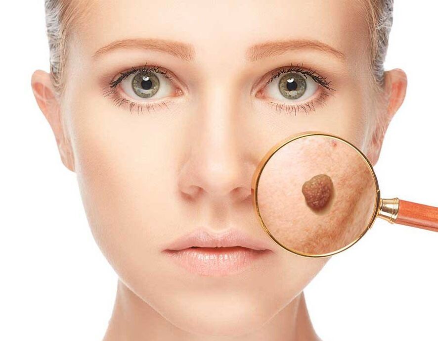 Papilloma on the face