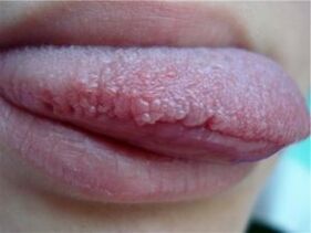 Papilloma on the tongue