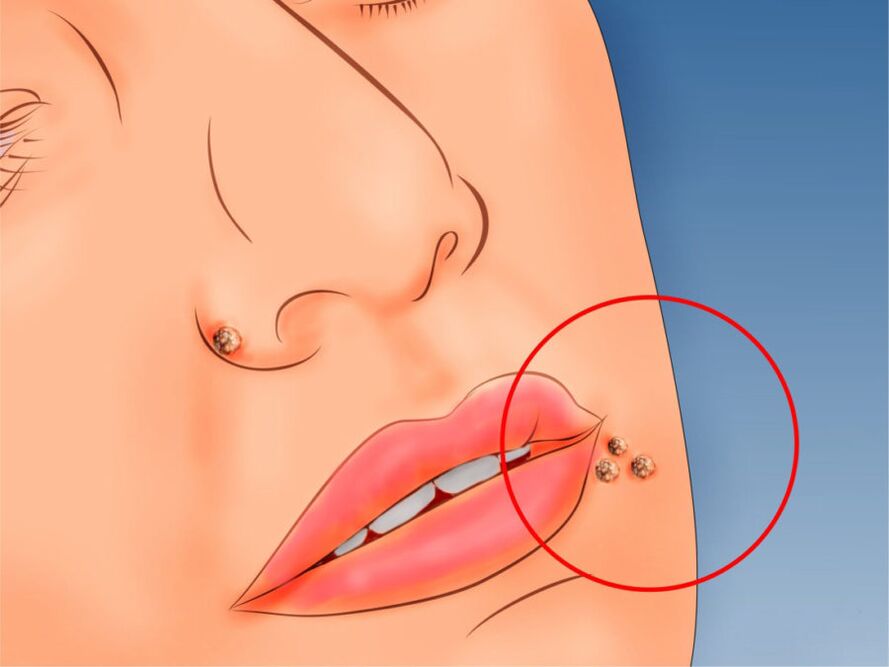 Papilloma on the face
