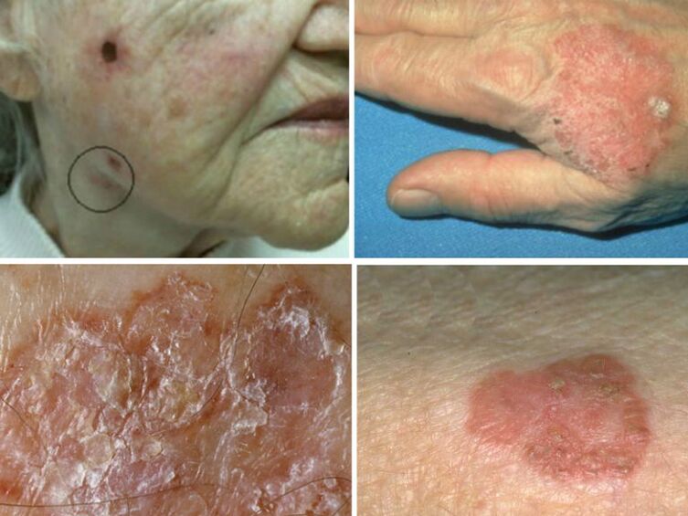 Bowen disease with HPV