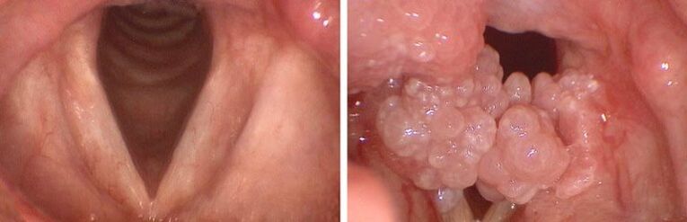 clear throat and papilloma in pharynx